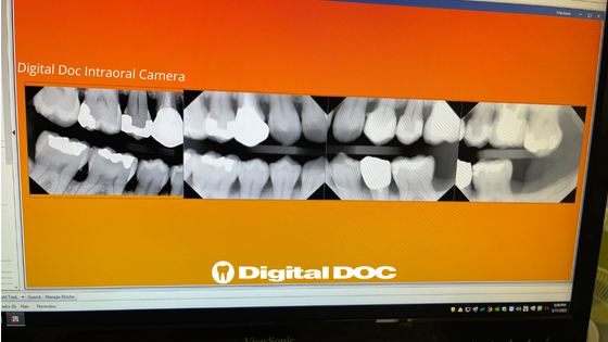 Upgrade Your Intraoral Camera